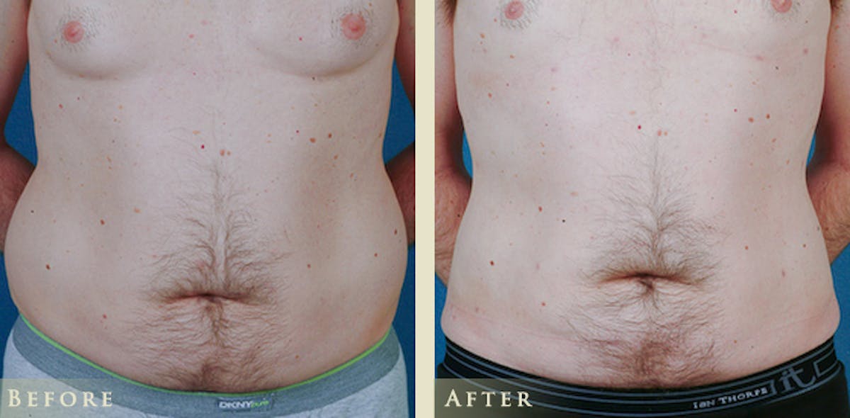 Male Liposuction Before & After Gallery - Patient 363835 - Image 2