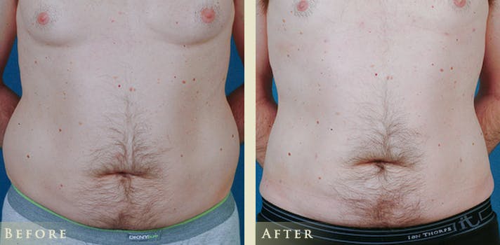 Male Liposuction Before & After Gallery - Patient 363835 - Image 2