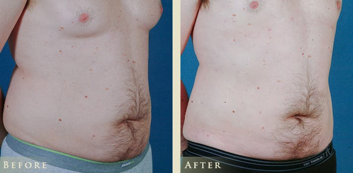 Male Liposuction Before & After Gallery - Patient 363835 - Image 3