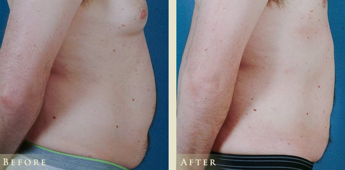 Male Liposuction Before & After Gallery - Patient 363835 - Image 4