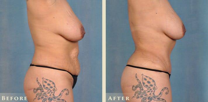 Tummy Tuck Before & After Gallery - Patient 246163 - Image 5