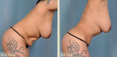 Tummy Tuck Before & After Gallery - Patient 246163 - Image 6
