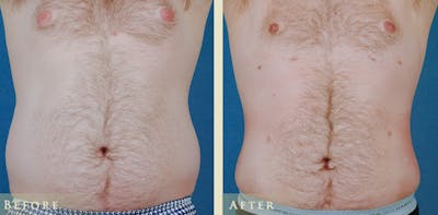 Male Liposuction Before & After Gallery - Patient 752317 - Image 1