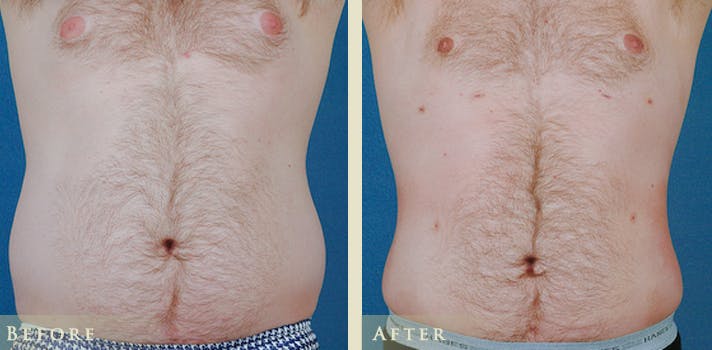 Male Liposuction Before & After Gallery - Patient 752317 - Image 1