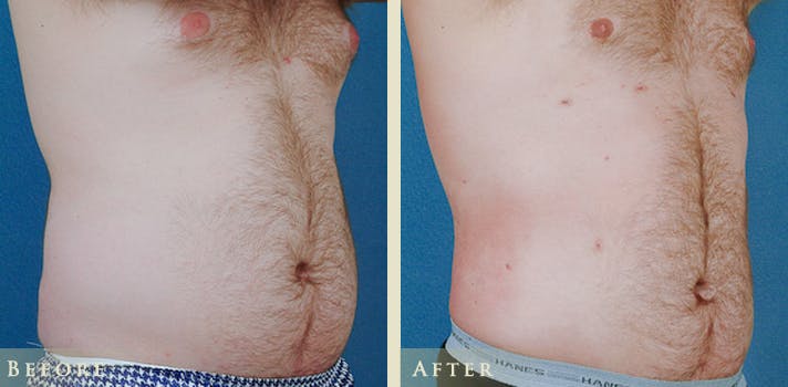 Male Liposuction Before & After Gallery - Patient 752317 - Image 2