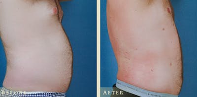 Male Liposuction Before & After Gallery - Patient 752317 - Image 3