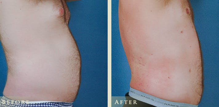 Male Liposuction Before & After Gallery - Patient 752317 - Image 3