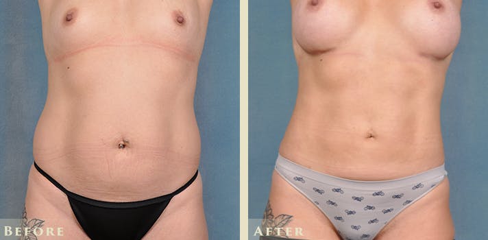 Tummy Tuck Before & After Gallery - Patient 149035 - Image 1