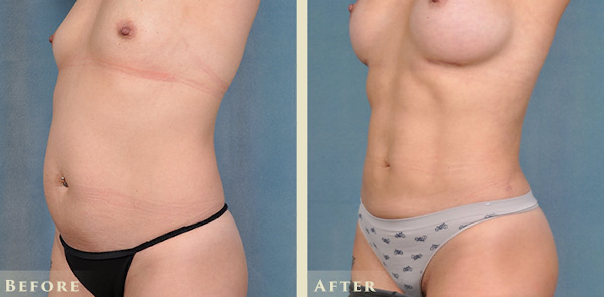 Tummy Tuck Before & After Gallery - Patient 149035 - Image 2