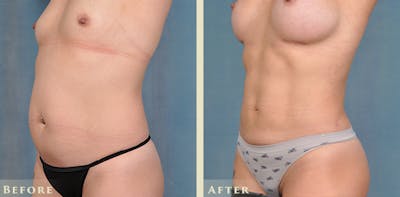 Tummy Tuck Before & After Gallery - Patient 149035 - Image 2