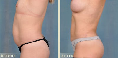 Tummy Tuck Before & After Gallery - Patient 149035 - Image 3