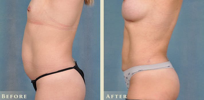 Tummy Tuck Before & After Gallery - Patient 149035 - Image 3