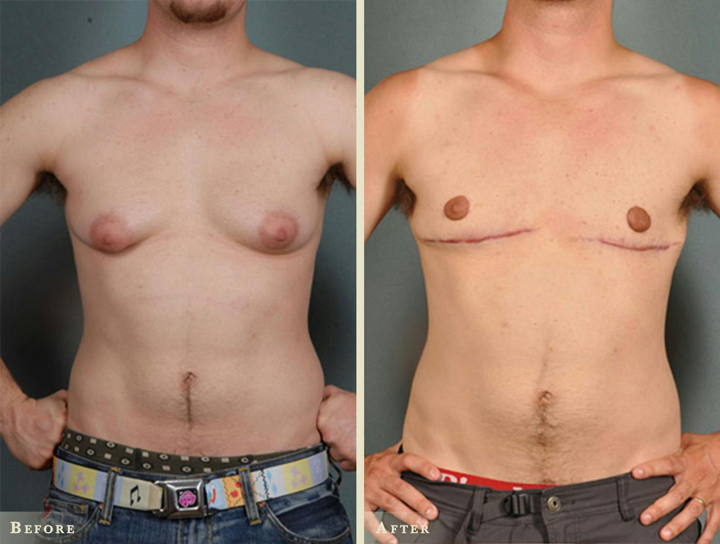 Male Breast Reduction (Gynecomastia) Before & After Gallery - Patient 479942 - Image 1