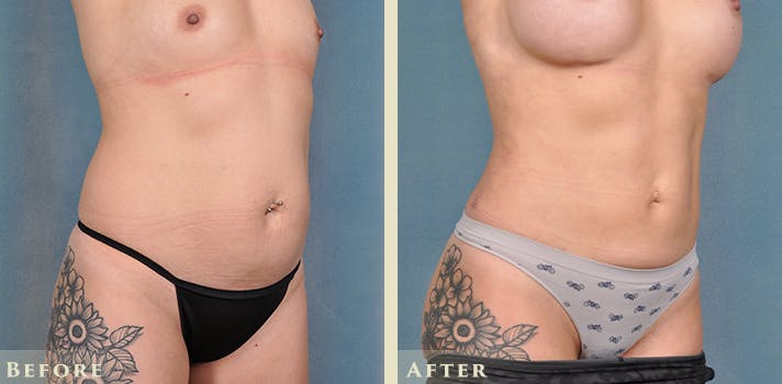 Tummy Tuck Before & After Gallery - Patient 149035 - Image 4