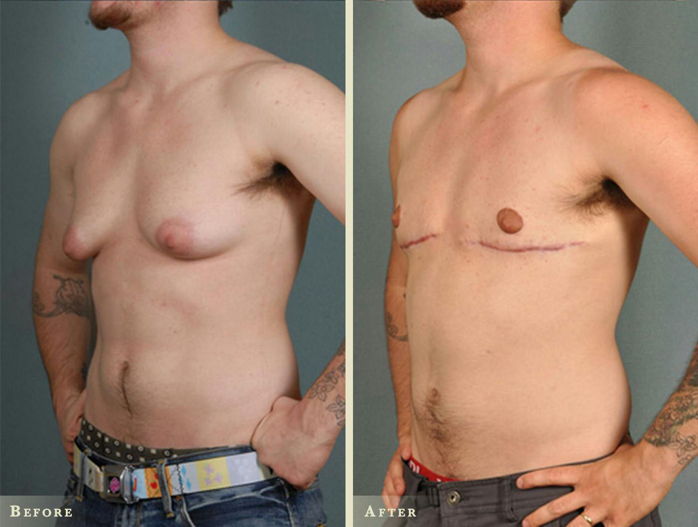 Male Breast Reduction (Gynecomastia) Before & After Gallery - Patient 479942 - Image 2