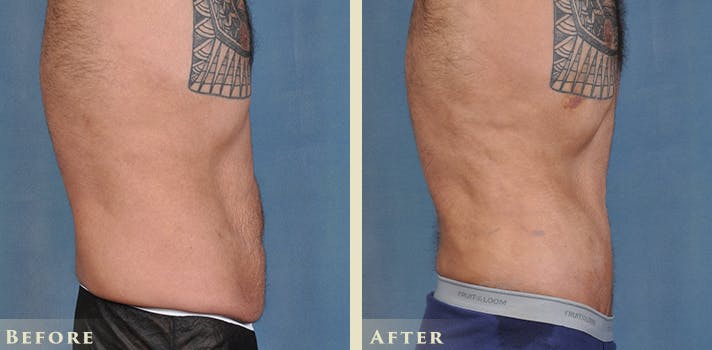 Male Liposuction Before & After Gallery - Patient 403824 - Image 3