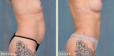 Tummy Tuck Before & After Gallery - Patient 149035 - Image 5