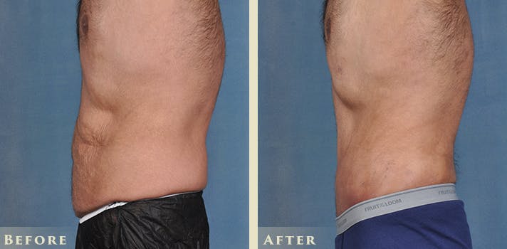 Male Liposuction Before & After Gallery - Patient 403824 - Image 4