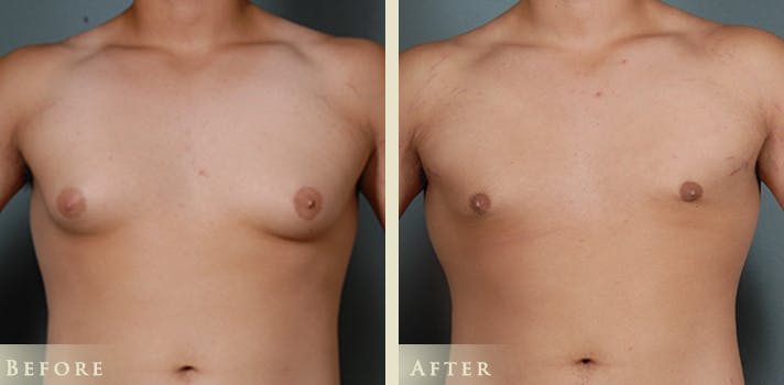 Male Breast Reduction (Gynecomastia) Before & After Gallery - Patient 132107 - Image 1