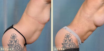 Tummy Tuck Before & After Gallery - Patient 149035 - Image 6