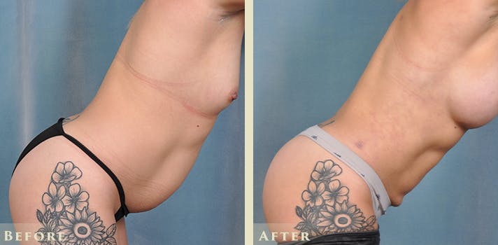 Tummy Tuck Before & After Gallery - Patient 149035 - Image 6
