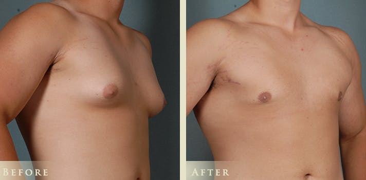 Male Breast Reduction (Gynecomastia) Before & After Gallery - Patient 132107 - Image 2