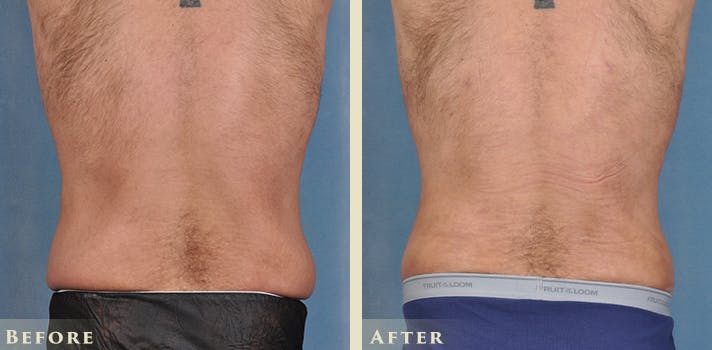 Male Liposuction Before & After Gallery - Patient 403824 - Image 5