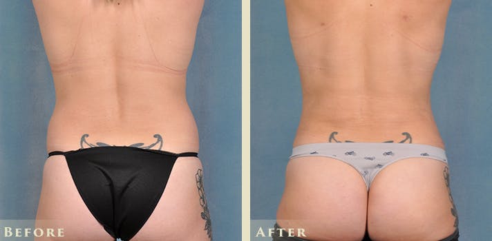 Tummy Tuck Before & After Gallery - Patient 149035 - Image 7