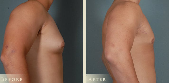 Male Breast Reduction (Gynecomastia) Before & After Gallery - Patient 132107 - Image 3