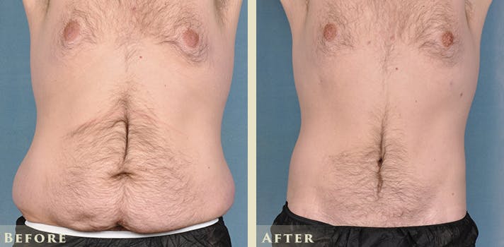 Male Liposuction Before & After Gallery - Patient 160216 - Image 1