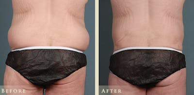 Male Tummy Tuck Before & After Gallery - Patient 361299 - Image 1