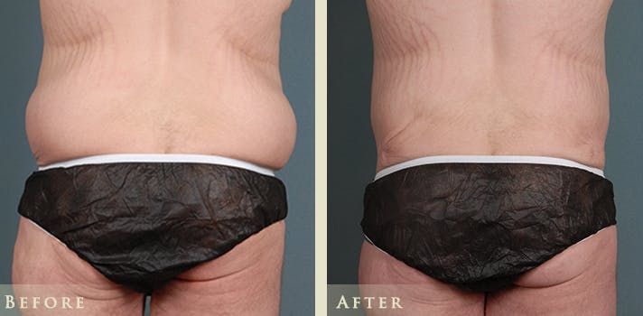 Male Tummy Tuck Before & After Gallery - Patient 361299 - Image 1