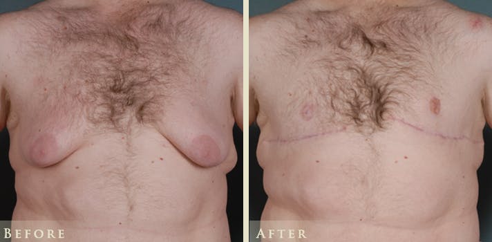 Male Breast Reduction (Gynecomastia) Before & After Gallery - Patient 518894 - Image 1
