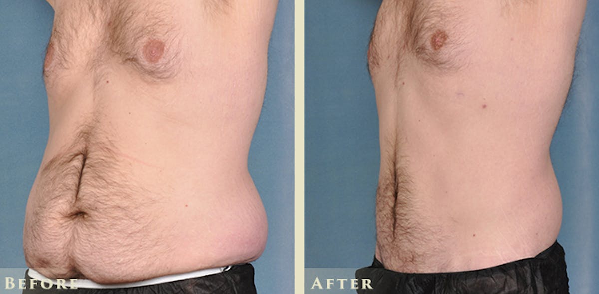 Male Liposuction Before & After Gallery - Patient 160216 - Image 2