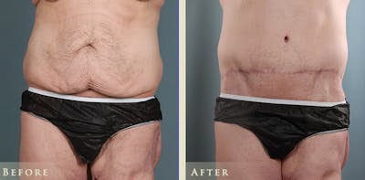 Male Tummy Tuck Before & After Gallery - Patient 361299 - Image 2