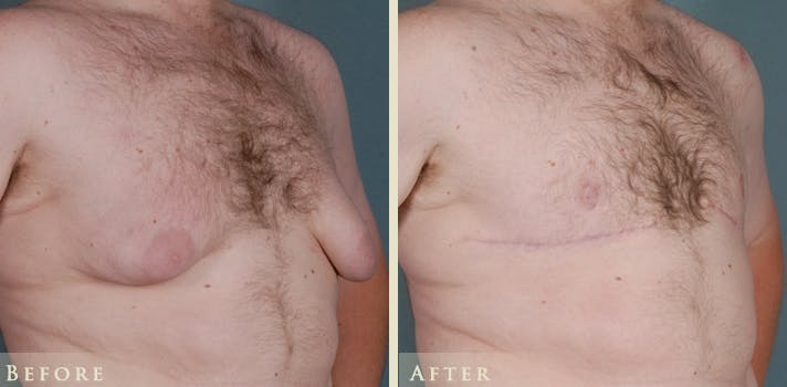 Male Breast Reduction (Gynecomastia) Before & After Gallery - Patient 518894 - Image 2