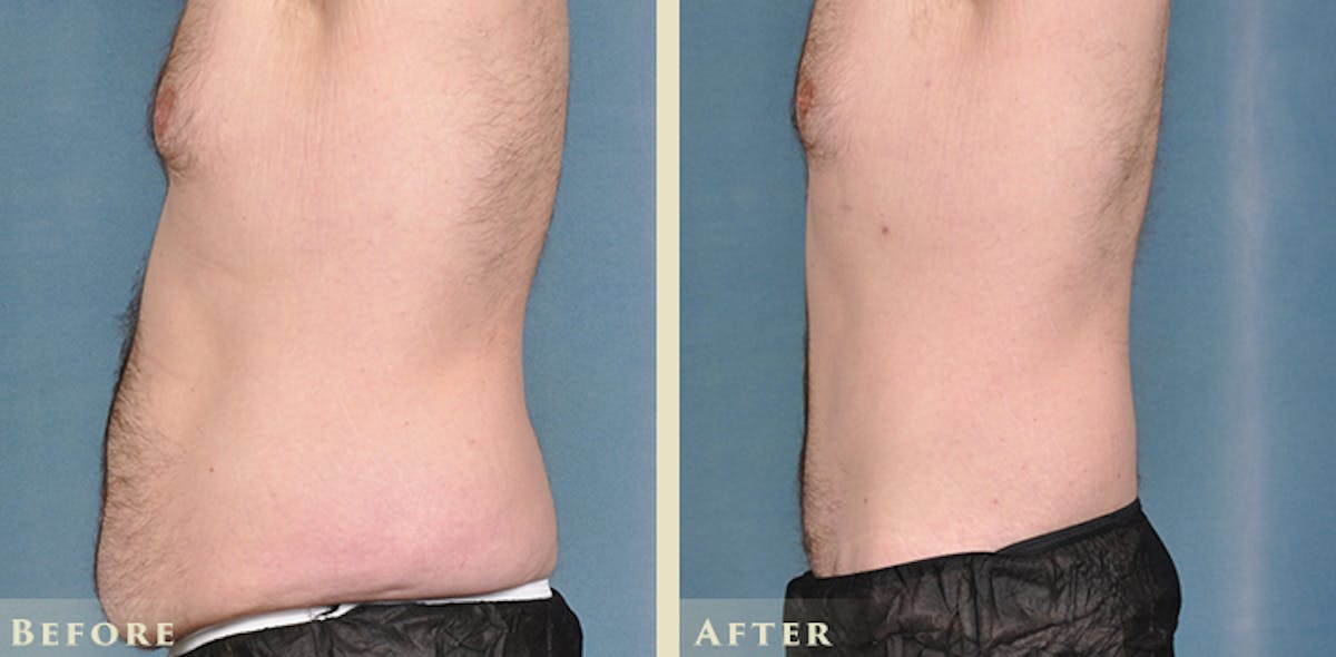 Male Liposuction Before & After Gallery - Patient 160216 - Image 3