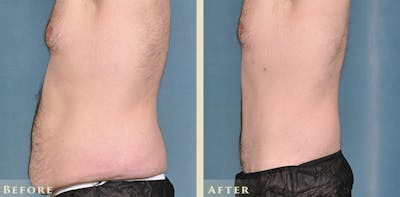 Male Liposuction Before & After Gallery - Patient 160216 - Image 3