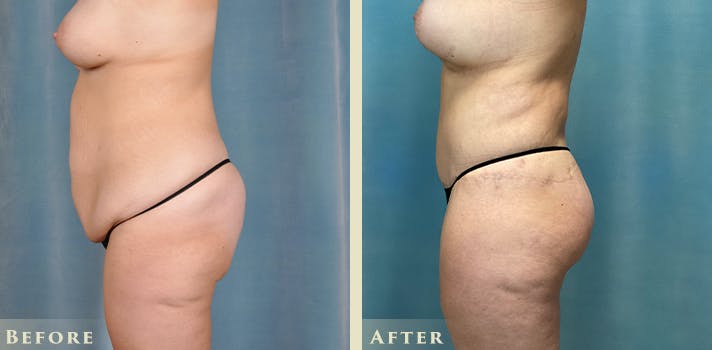 Tummy Tuck Before & After Gallery - Patient 206048 - Image 3