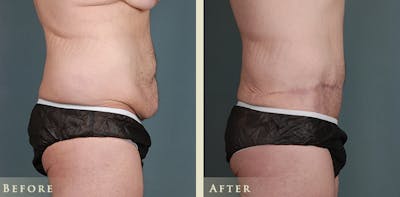 Male Tummy Tuck Before & After Gallery - Patient 361299 - Image 3
