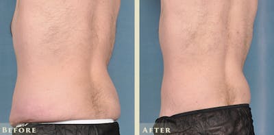 Male Liposuction Before & After Gallery - Patient 160216 - Image 4