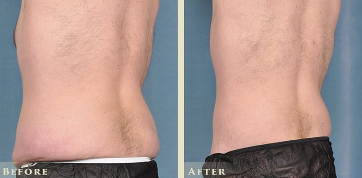 Male Liposuction Before & After Gallery - Patient 160216 - Image 4