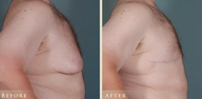 Male Breast Reduction (Gynecomastia) Before & After Gallery - Patient 518894 - Image 3