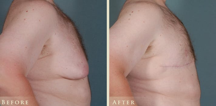 Male Breast Reduction (Gynecomastia) Before & After Gallery - Patient 518894 - Image 3