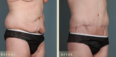 Male Tummy Tuck Before & After Gallery - Patient 361299 - Image 4