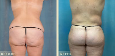 Tummy Tuck Before & After Gallery - Patient 206048 - Image 5