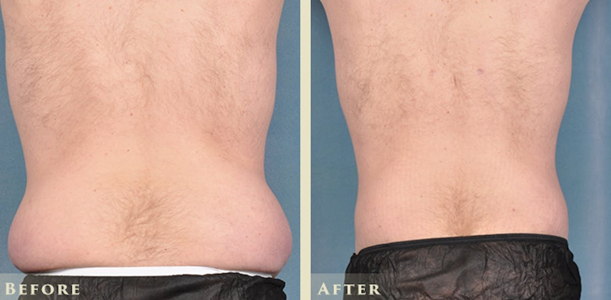 Male Liposuction Before & After Gallery - Patient 160216 - Image 5