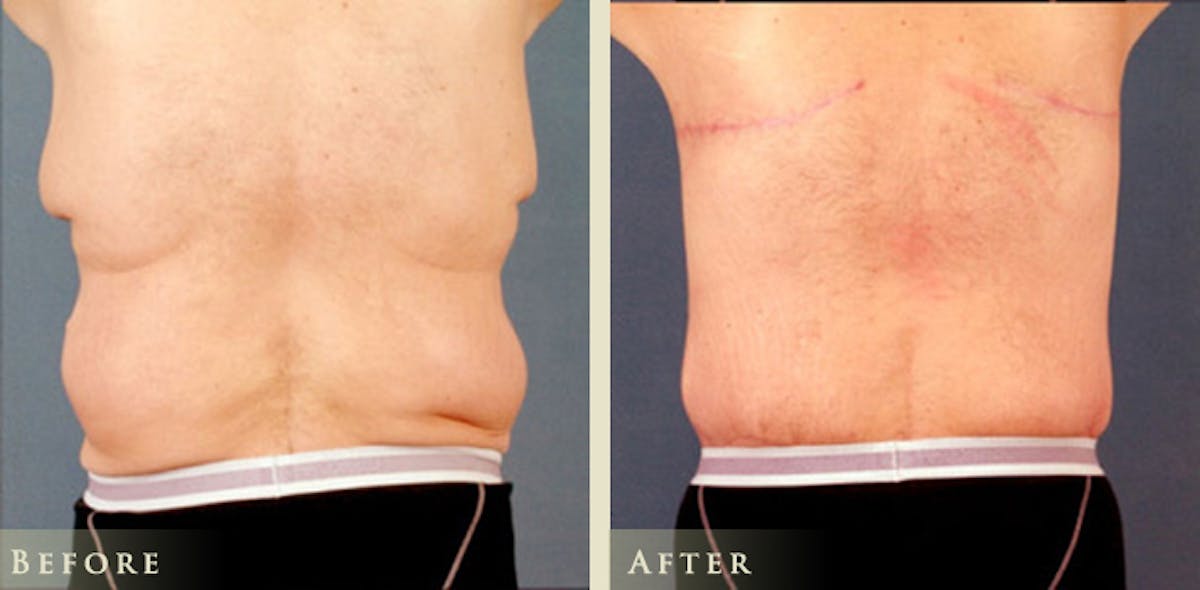 Male Breast Reduction (Gynecomastia) Before & After Gallery - Patient 114118 - Image 1