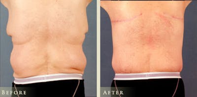 Male Breast Reduction (Gynecomastia) Before & After Gallery - Patient 114118 - Image 1