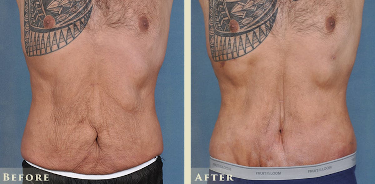 Male Tummy Tuck Before & After Gallery - Patient 205318 - Image 1